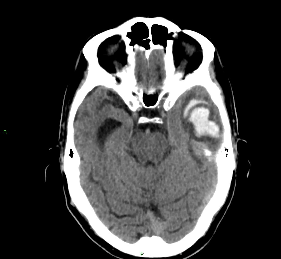 Cerebral amyloid angiopathy-associated lobar intracerebral hemorrhage ...