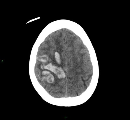 Cerebral amyloid angiopathy-associated lobar intracerebral haemorrhage ...