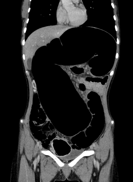 Sigmoid volvulus | Image | Radiopaedia.org