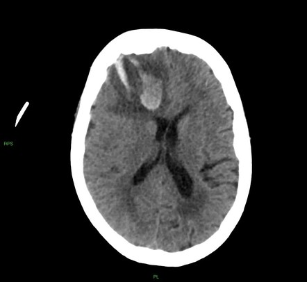 Cerebral Amyloid Angiopathy-associated Lobar Intracerebral Hemorrhage 