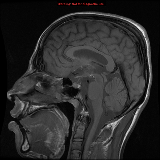 Intracranial dermoid: with rupture | Image | Radiopaedia.org