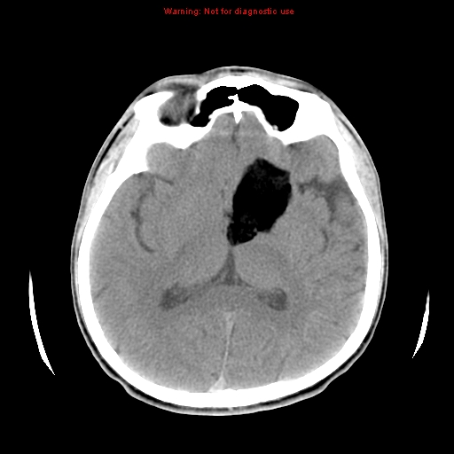 Ruptured Intracranial Dermoid Cyst Image 5891