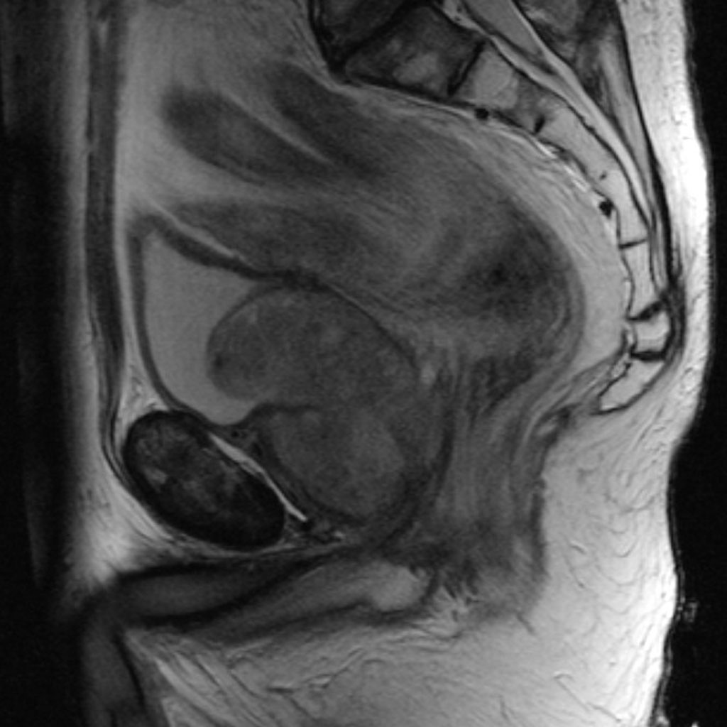 Benign Prostatic Hyperplasia Image 9096