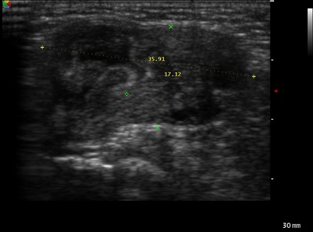 Canal of Nuck hernia containing ovary | Radiology Case | Radiopaedia.org