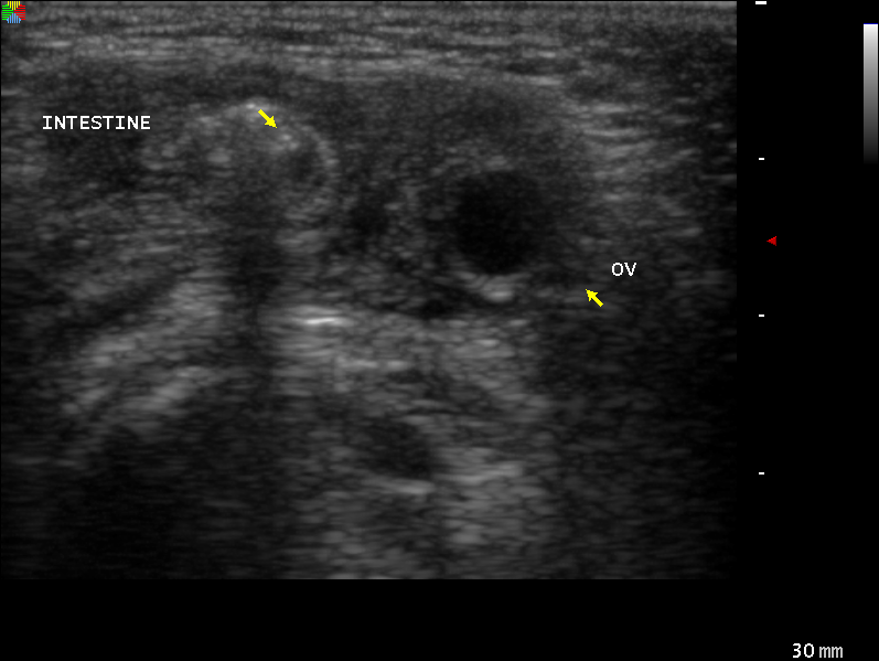 Canal of Nuck hernia containing ovary | Image | Radiopaedia.org