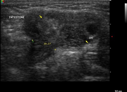 Canal of Nuck hernia containing ovary | Image | Radiopaedia.org