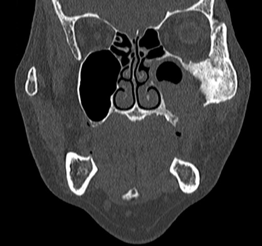 Maxillary Sinus Squamous Cell Carcinoma Image 