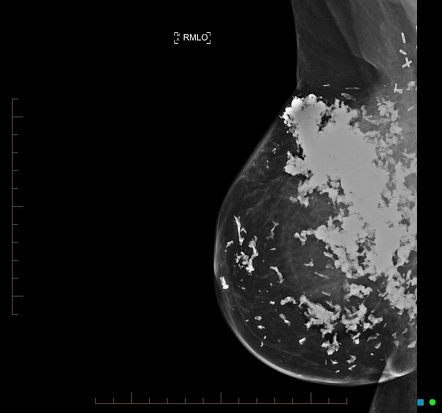 Dystrophic Calcification Within The Breast Radiology Reference Article Radiopaedia Org