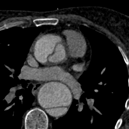 Beak sign of aortic dissection | Radiology Case | Radiopaedia.org