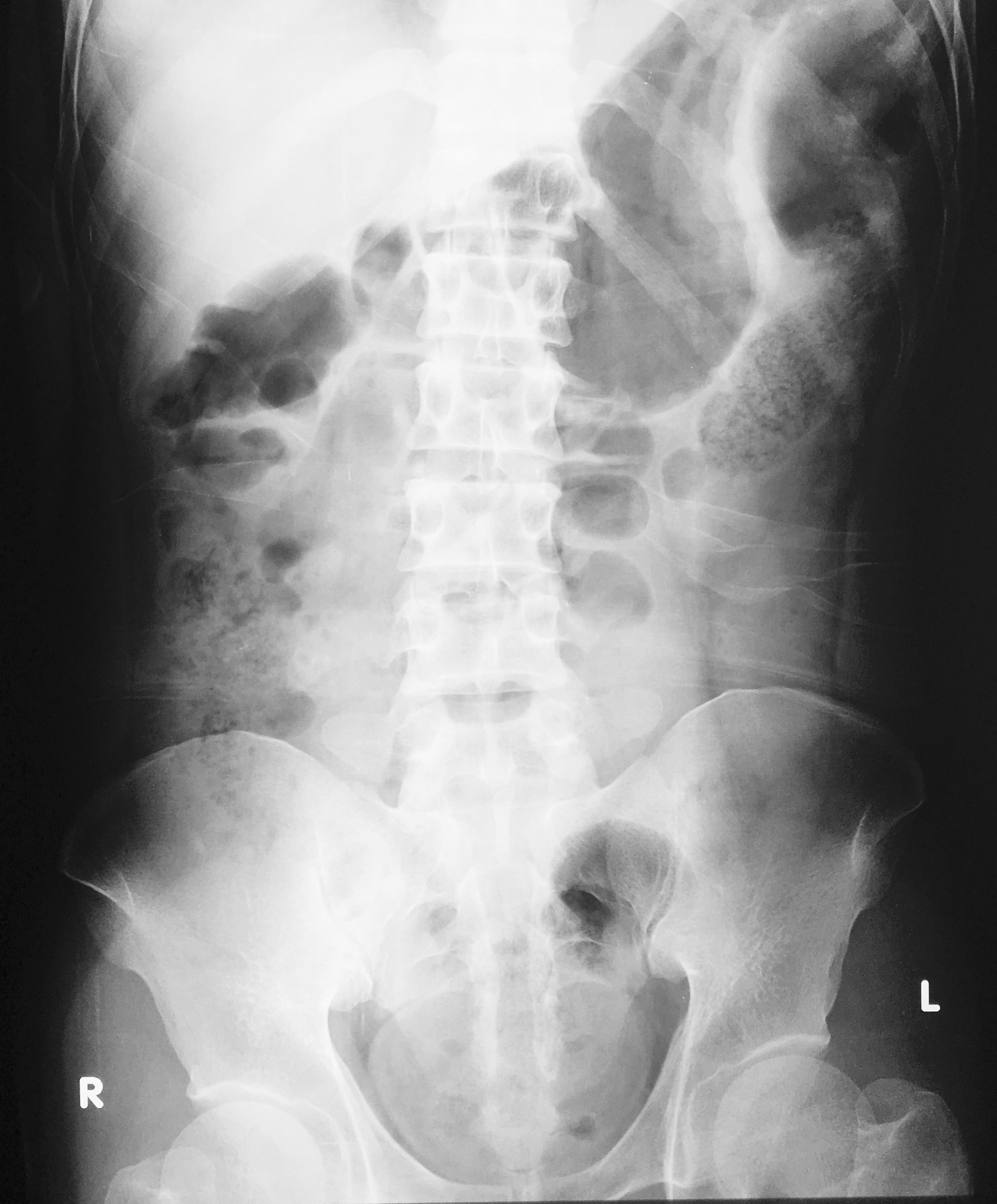 Traumatic small bowel perforation handlebar injury Image