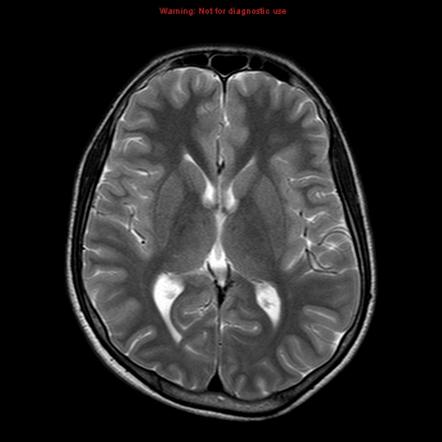 Cortical dysplasia with cerebellar hemisphere aplasia | Image ...