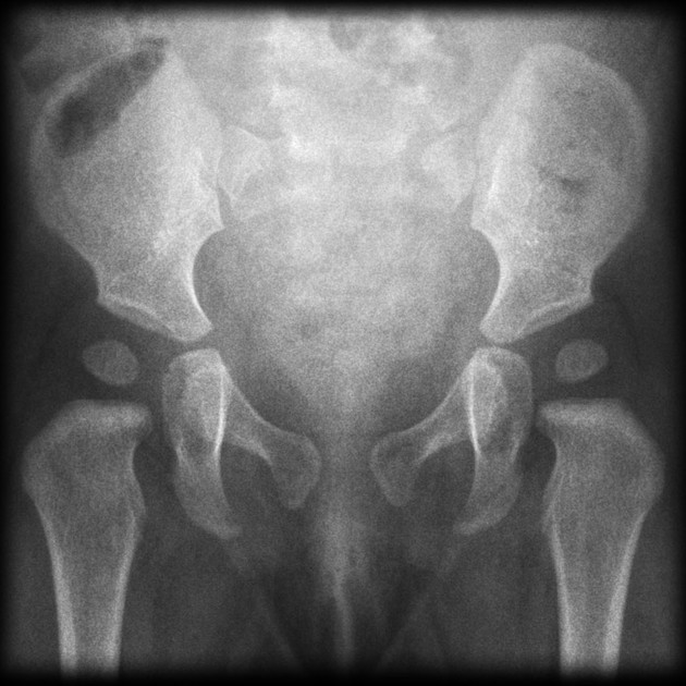 Pelvic x ray different ages Radiology Case Radiopaedia