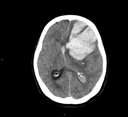 Cerebral amyloid angiopathy-associated lobar intracerebral hemorrhage ...