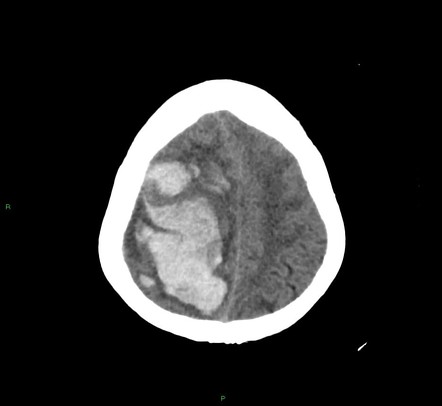 Cerebral amyloid angiopathy-associated lobar intracerebral hemorrhage ...