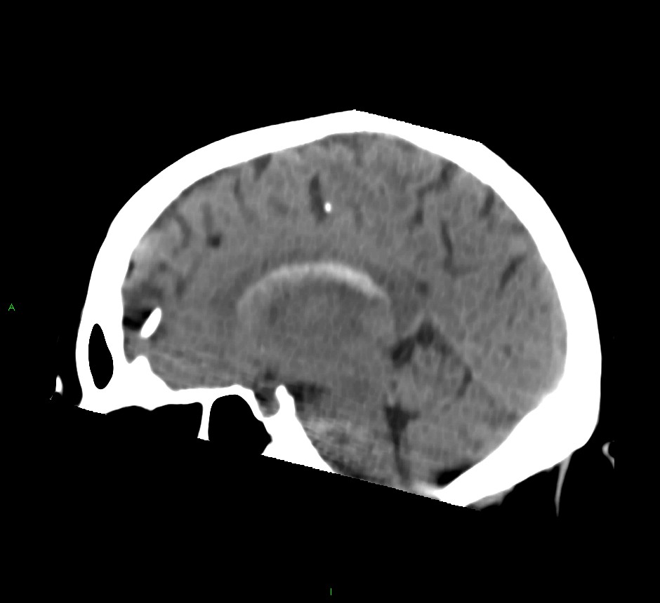 Basal ganglia hemorrhage | Image | Radiopaedia.org