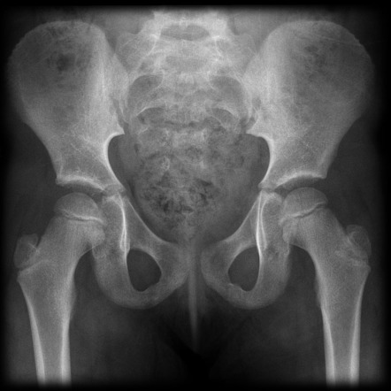 Pediatric pelvis (AP view) | Radiology Reference Article | Radiopaedia.org