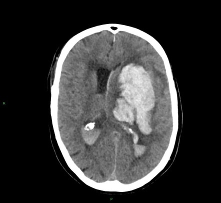 Basal ganglia hemorrhage | Radiology Case | Radiopaedia.org