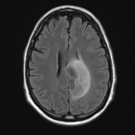 Gemistocytic astrocytoma (historical) | Radiology Reference Article ...