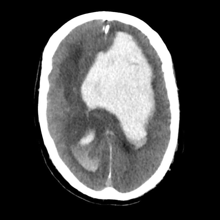 Lobar intracerebral hemorrhage | Image | Radiopaedia.org