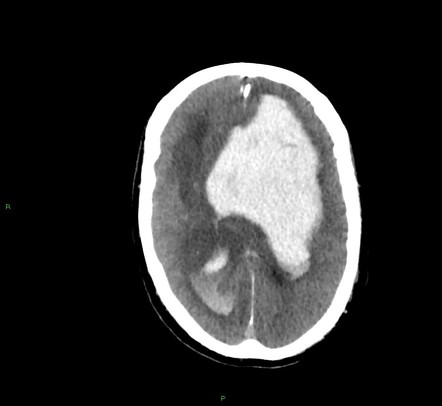 Lobar intracerebral hemorrhage | Radiology Case | Radiopaedia.org