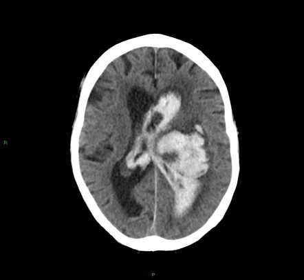 Thalamic hemorrhage | Radiology Case | Radiopaedia.org