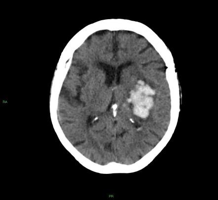 Basal ganglia hemorrhage | Image | Radiopaedia.org