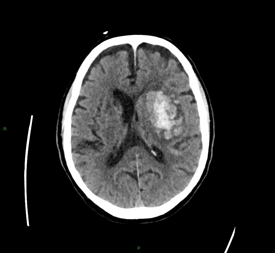 Basal ganglia hemorrhage | Image | Radiopaedia.org