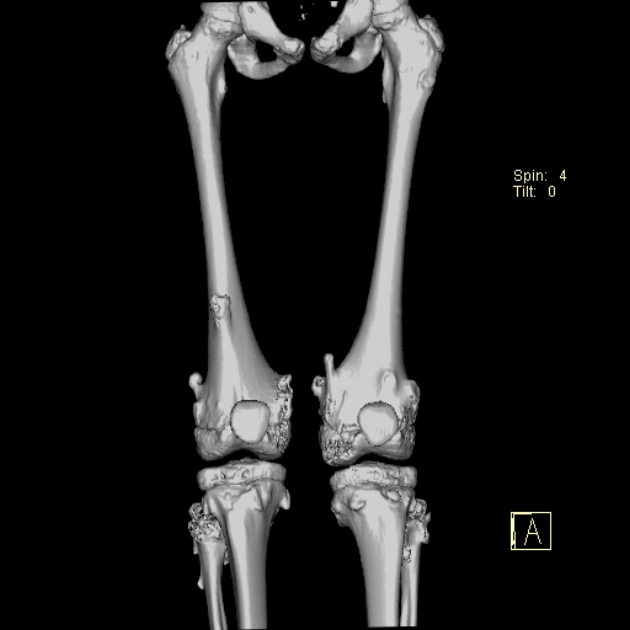 Diaphyseal aclasis | Image | Radiopaedia.org