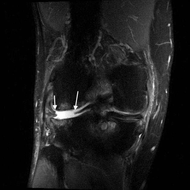 Radial tear of the lateral meniscus | Image | Radiopaedia.org