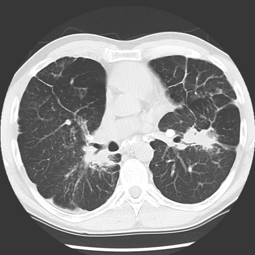 Sarcoidosis | Image | Radiopaedia.org