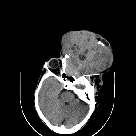 Rhabdomyosarcoma (orbit) | Radiology Reference Article | Radiopaedia.org