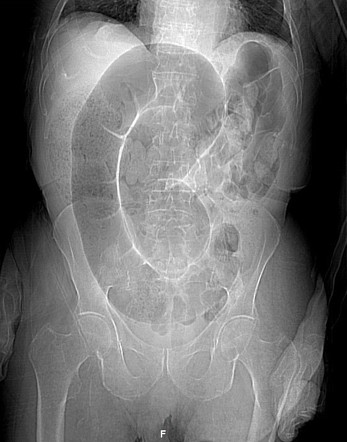 Northern Exposure Sign Sigmoid Volvulus Radiology Reference Article Radiopaedia Org