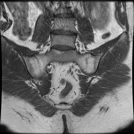 Fat metaplasia | Radiology Reference Article | Radiopaedia.org