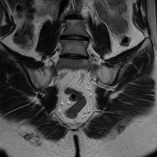 Sacroiliitis | Image | Radiopaedia.org