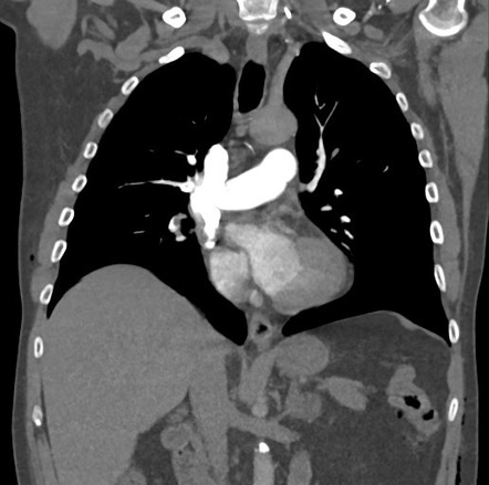 Saddle pulmonary embolus | Image | Radiopaedia.org