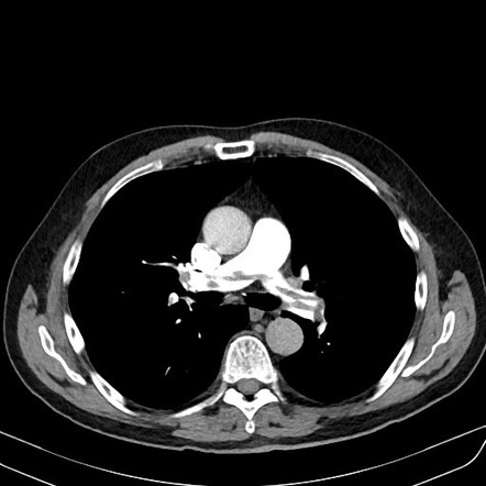 CT pulmonary angiogram (technique) | Radiology Reference Article ...