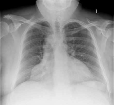 Pericardial cyst with right aortic arch | Radiology Case | Radiopaedia.org