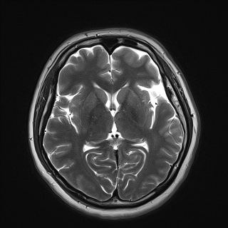 Sturge-Weber syndrome | Image | Radiopaedia.org