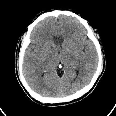 Cardioembolic stroke: ACA and MCA territories | Image | Radiopaedia.org