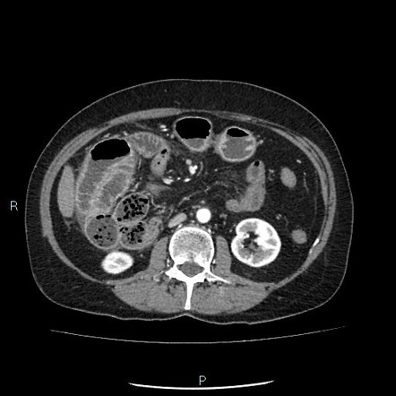 Right paraduodenal hernia | Image | Radiopaedia.org