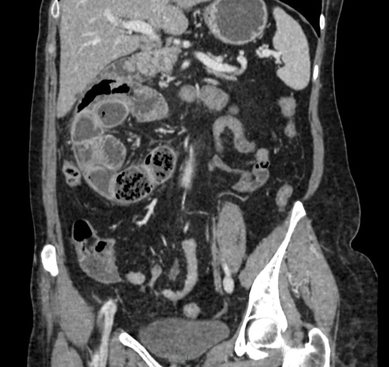 Right Paraduodenal Hernia Image