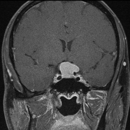 Intracranial Yolk Sac Tumor 