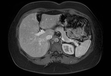 Normal Liver Mri With Gadolinium 