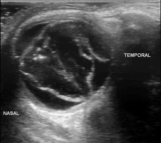 Retinal and choroid detachment | Image | Radiopaedia.org