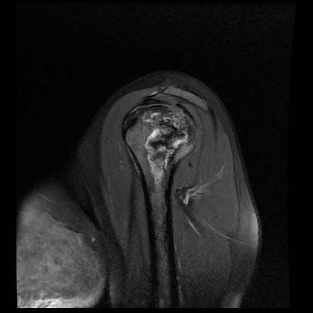 Avascular necrosis of humerus | Image | Radiopaedia.org