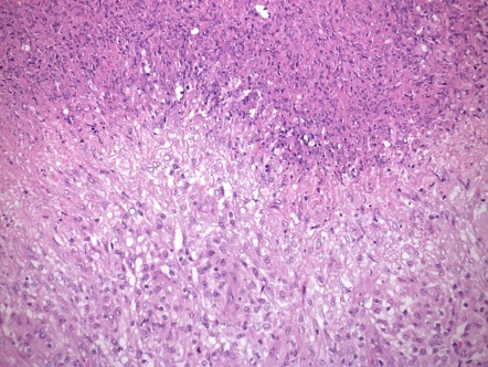 Necrotizing granulomatous epididymo-orchitis (pathology) | Image ...