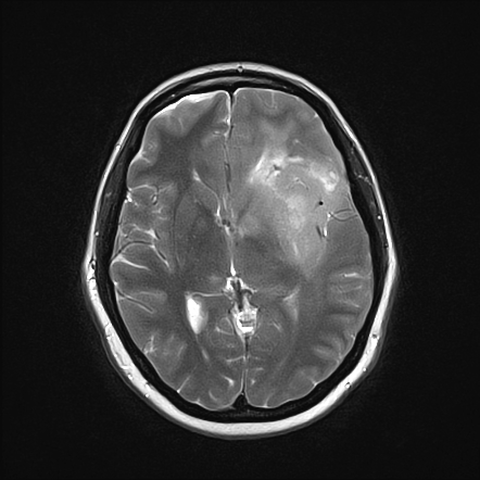 Anaplastic astrocytoma | Radiology Reference Article | Radiopaedia.org