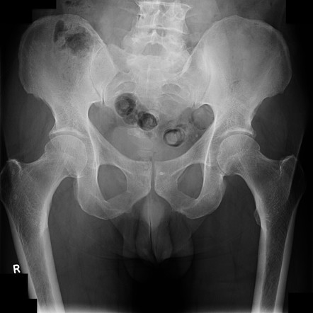 Bladder Calculus | Radiology Case | Radiopaedia.org