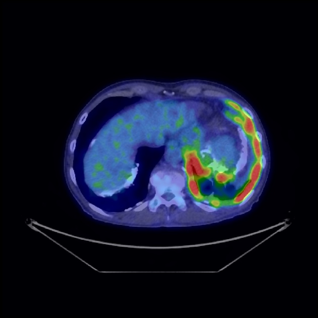 Mesothelioma | Radiology Reference Article | Radiopaedia.org