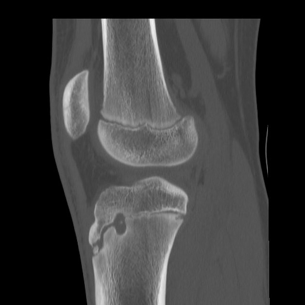 Brodie abscess of the tibia Radiology Case Radiopaedia